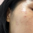 [미금 피부과 추천] 미소앤의원 주근깨 기미 레이저 클라리티 내돈내산 솔직후기