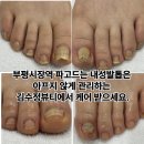 부평시장역 파고드는 내성발톱은 아프지 않게 관리하는 김수정뷰티에서 케어 받으세요.