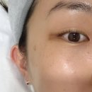 동그라미스킨케어 | 인덕원 스킨부스터 더마샤인 물광주사 스킨케어 2회차 후기