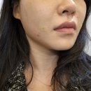 모즈의원 | 팔자주름 고민 해결! 모즈의원 팔자 실리프팅 + 필러 멍 없는 후기