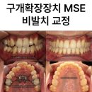 능치과의원 | 상악 폭경이 좁고 심한 비뚤함, MSE(MARPE) 악궁확장장치 비발치 교정 후기 | 송파 잠실 교정치과