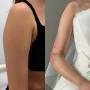 때빼멍 | 팔 지방추출주사 후기 멍과 붓기 (예식 전 회복과정 공개)