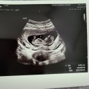 대추밭약국 | 경주 대추밭백한의원 한약 복용후기 , 삼신할배 진료 임신성공