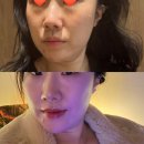 올 | 동대문피부과 처진 얼굴 올타이트 후기 통증, 다운타임 없는 리프팅