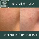 연세새살의원 | [신촌 여드름흉터 신촌 모공] 꼼꼼한의원 채움침으로 새살 차올리세요