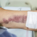 씨엘의원 | 팔지방흡입 통증/부작용, 확률 '확' 낮추는 핵심_의사작성