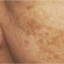 루비 | 영등포루비레이저, 후기 궁금하다면?