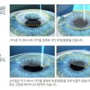 친절한푸른약국 | [후기] 구월동 푸른 세상 안과 스마일라식 1년 후기✨