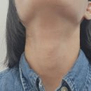 6056 | 압구정 목주름 시술 후기 바이리즌 다비다성형외과