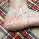 르사(LSA) | 르사덤 크림(Lsa Derm. Cream) : 발가락, 발뒤꿈치 무좀약 추천 솔찍 후기