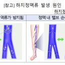 질병치료 목적이 아닌 외모개선 목적의 수술 등은 실손보험 보장 대상에 해당하지 않습니다[하지정맥류:0.5초 이상의 혈액의 역류] 이미지