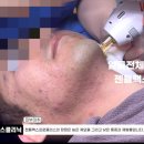 필옵틱스3공장 | 수원남자수염제모 얼굴전체 &amp; 앞목 젠틀맥스프로플러스 시술동영상 2026_05_21 인계동 원스의원