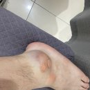 점액낭염 이유와 치료 후기!! 안양 더샘찬정형외과의원 방문 후기 및 일주일 후기!!