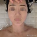 매일참사랑의원 | 강남구청피부관리 직장인관리 리베아에스테틱에서 티리온엑스 리프팅 받은 후기