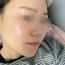 킨 | :: 창동역 피부과 추천 :: 인퓨스킨 후기 눈밑+옆볼 꺼짐 스킨부스터 솔직후기