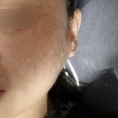 아이스킨 | 주름관리 리쥬란힐러 아이리쥬란 스킨보톡스 후기 리쥬란통증