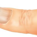 철결핍성 빈혈[iron deficiency anemia] 이미지
