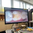 해바라기치과의원 | 문현동 해바라기치과 충치 인레이 떨어짐 치료시작 1차 방문