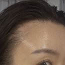 (주)한국메디칼 | 피부과 탈모 줄기세포 모발두피주사 MCT 메타셀 내돈내산 솔직 후기