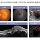 실명 원인 1위 황반변성 증상 및 원인과 치료방법 확실한 자가진단법 이미지