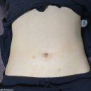 김씨 복부 림프관리 | 평택 고덕동피부과 러브핸들 복부주사 내돈내산 가격 효과 후기