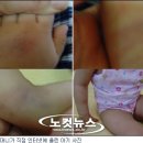 '친구 깨문다' 어린이집 원장이 3살 여아 폭행 이미지