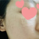 삼산바른한의원 | 피부고치기) 얼굴 편평사마귀 &amp; 울산 삼산 강남피부과 레이저 치료 후기