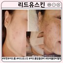 의정부여드름 관리 | 리드유스킨 개별 맞춤 트러블관리 여드름압출 진정재생 리드유필 진주필 후기