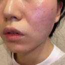 유앤영피부과의원 | 노원 피부과 여드름 트러블 모공 흉터 레이저 유앤영 피부과 후기 / 실펌X 실펌엑스 미라젯 쥬베룩볼륨...