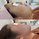 전주 피부관리 1회만으로도 효과가 굉장한 슈퍼젝션 &#34;새싹뷰티&#34;에서 받은 찐 후기