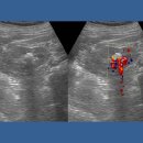 Twinkling Artifact of Renal Stone 이미지