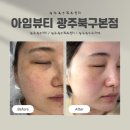 광주북구기미 고민 색소관리 잘하는 아임뷰티 광주북구본점 후기