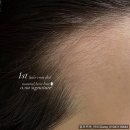 모델헤어라인 | 영등포 승준생 헤어라인, 가격+후기 총 정리