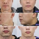 수염제모 고인물의 제모 가이드 이미지