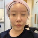 빗살무늬주 | (리얼) 슈링크 600샷 vs 세르프 300샷, 통증·붓기·효과 비교