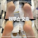 엘앤제이커피 | [청주 오송 각질관리] 부끄럽던 발뒤꿈치… 아기 발로 재탄생! ‘레푸스 오송점’ 발 각질 케어 후기