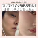 신대피부과 | 순천피부과 피코토닝 후기, 순천색소침착 주근깨 관리 솔직후기
