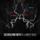 모야모야병 증상 뇌출혈 뇌혈류 감소 운전 위험성 이미지