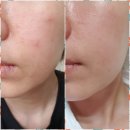 4일전부터 왼쪽입가에 사진처럼 빨갛에 달아올랐더라고요 만져보니 좁쌀처럼 뭐가 한두개 만져지긴...
