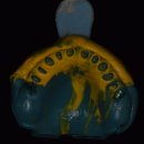 예쁜턱치과기공소 | 전공의 시절 80세 어머님의 무너진 미소, 손끝으로 다시 세우다 (두류역 치과 )