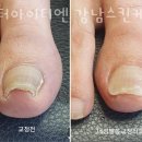 케어네일 이미지