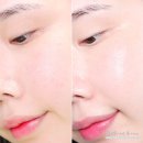 강남역 미술관 피부과 기미 잡티 피코토닝 레이저 & 비타민관리 솔직후기