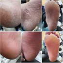 굿네일 | 양주 옥정 발각질 심한각질 고민될 땐 여기, 굿네일