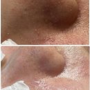 오제이뷰티아카데미 | 광주좁살여드름 압출과 피부타입맞춤케어 /수완지구피부관리 르네에스테틱/좁살트러블 패키지!