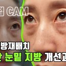 [4K] 혹시 내 눈도? 중년여성 눈밑지방재배치 밀착 CAM! 수술전부터 두달차 까지! 붓기 경과 알려드려요! 이미지