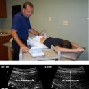 복벽의 두깨, 다열근의 두깨 변화에 따른 요통의 예후에 관한 논문 이미지