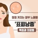 표피낭종 이미지