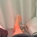 병방한의원 | 20대 남자 발목인대 파열 후기 (3일차/4일차)