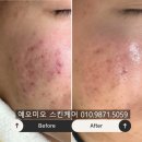 위드미 의정부금오점 | 의정부 금오동 여드름 관리 효과 본 후기, 재방문율 높은 이유