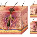 여드름 흉터, 화농성 트러블이 깊은 흉터로 이어지는 이유와 여름철 관리법 | 로담한의원 부산